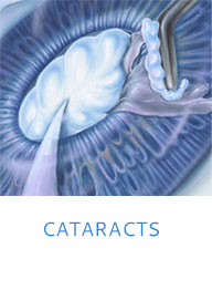 Cataracts